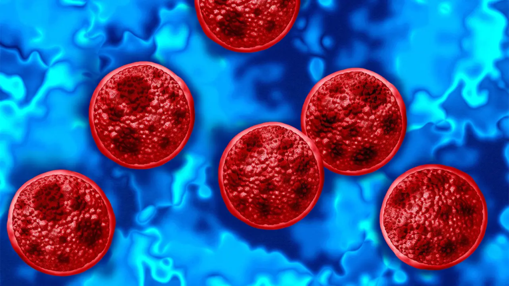 Cyclosporiasis Case Confirmed In Cayman Islands Cyclosporiasis Case Confirmed In Cayman Islands